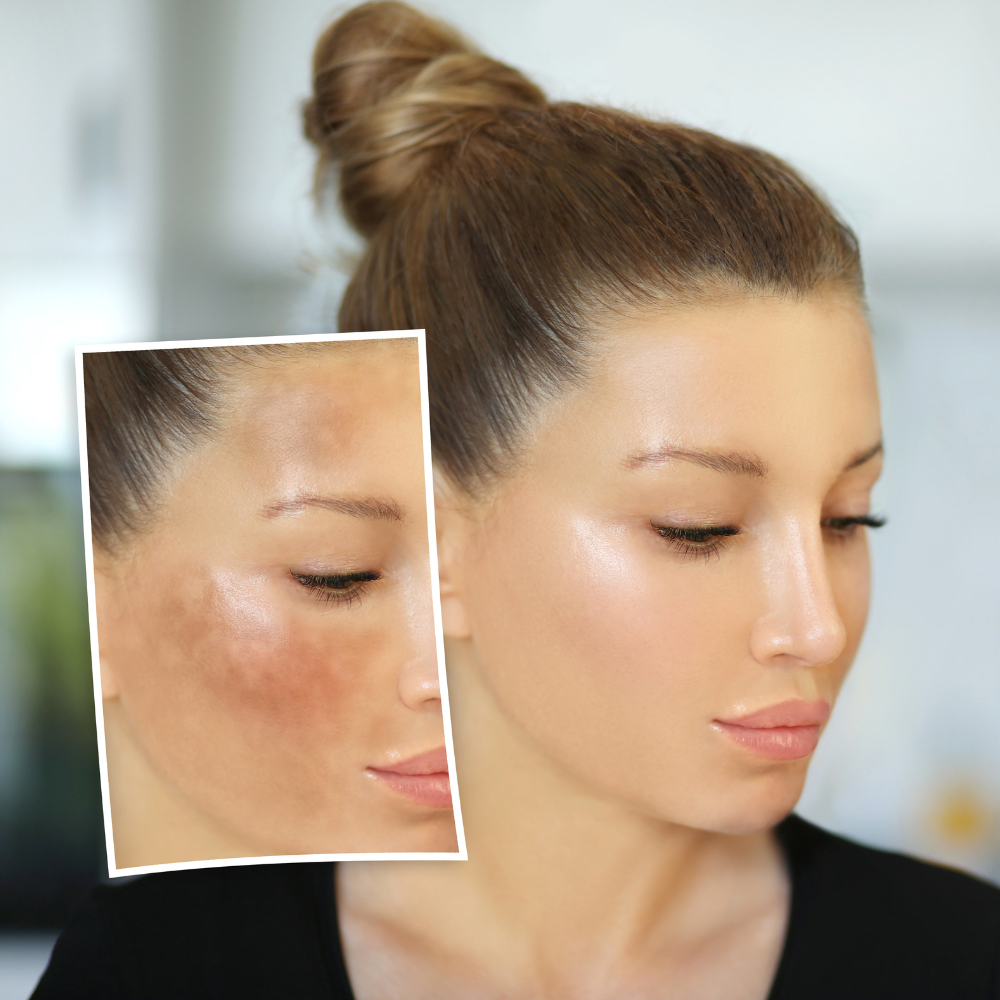 Dark spots